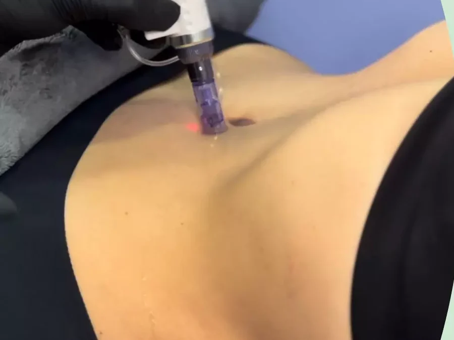 MesoSlim